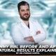 Skinny BBL Before and After Natural Results Explained by Dr. Furkan Certel